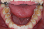 Figure 3  Left untreated and without preventiveadvice, erosion will continue to develop. Inthis case, the erosion had started to attackmost tooth surfaces, making sensitivity a commonfinding.