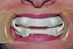 Fig 2. A mandible forward displacement appliance.
