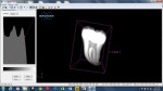 The same micro-CT scan from Figure 4 is visualized as sectional views (Dataviewer,
Micro Photonics Advanced Instruments, www.microphotonics.com) and as a 3D model (CTvox, Micro Photonics Advanced Instruments). These programs offer a comparative and scaled cross sectional view of tooth scans to accurately reveal internal anatomy and aberrations in tooth structure that may indicate additional specialized endodontic instrumentation or techniques.