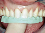 Figure 7  Preparation guides made from thediagnostic wax-up were used to verify the facialand incisal reduction.