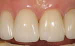 Figure 1  Chipped porcelain in the anteriorregion is a common problem that can occur inthe general practice.