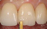 Figure 2  A nano-hybrid composite resin is placedand sculpted to repair the chipped porcelain.
