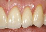 Figure 4  The ceramic restoration is chippedfrom excessive lateral excursive stress.