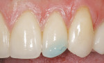 Figure 5  Conditioning of the ceramic restorationwith phosphoric acid acidifies and cleansesthe restorative surface before placing porcelainrepair adhesive.