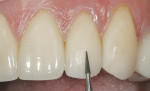 Figure 7  After restoring the chipped ceramicwith a nano-hybrid composite resin, finishing carbideburs are used to refine the restorative surface.