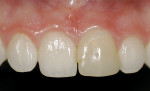 Figure 9  A broken and discolored ceramicrestoration can be repaired with minimally invasivetreatment.