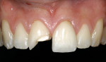 Figure 12  For long-term cosmetic restorativesuccess the ceramic restoration was replaced.Esthetic principles were used to naturally match theadjacent porcelain veneer and natural dentition.