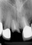Figure 1  Broken central incisor. Note the shortcrown-to-root ratio.
