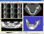 Figure 6a  Simplant surgical planning software.