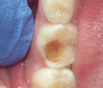The patient presented after an old restoration on tooth K had debonded.