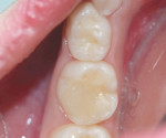 The tooth immediately after placement of the bulk-fill composite.