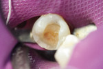 Excavation of caries removes large area of dentin and results in near exposure (see pink area: buccal portion of excavation).