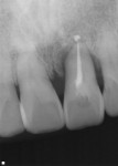 Preoperative radiograph of a failing tooth that is periodontally involved.