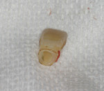 Patient’s natural tooth prepared for temporary placement.