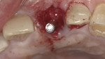 Implant placed inside the incisal line angle of the adjacent teeth.
