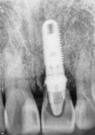 Radiograph of immediate implant placement with immediate temporization.