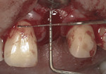 Depth of implant placement should be 3 to 4 mm below the cementoenamel junction of the adjacent teeth or the free gingival margin.