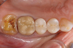 Figure 3  Tooth No. 15 was conservatively preparedto accommodate the all-ceramic CAD/CAMonlay.