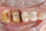 Figure 6  Tissue troughing was achieved with adiode laser to create clean, crisp margins.