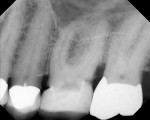 Figure 1  Pretreatment radiograph of molar case.