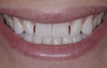 Preoperative smile showing spacing and rotations; note flat or reversed smile line when compared to the lower lip.