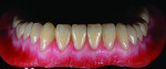 Fig 1. The returned screw-retained esthetic control base (ECB) and delivered wax try-in.