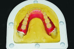 Fig 4. The wax try-in is invested in the Celara alginate.
