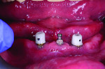 Fig 19. The clinician seats the primary telescopic abutments with a buccal indicator for positioning.