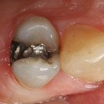 At patient presentation, tooth No. 4 had an existing amalgam restoration with a mesial marginal ridge fracture.
