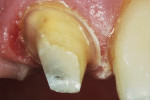 Figure 1  Facial view of the tooth preparation after placement of the post and core.