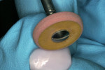 Figure 10  The pink pre-polish diamond-impregnatedCeramiPro™ Dialite was used followed bythe gray fine-grit CeramiPro™ Dialite wheel toachieve a high-gloss finish.