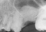 Radiograph following sinus elevation at site of tooth No. 14.