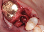 Following maxillary first molar extraction, a trephine core was created utilizing the interradicular bone.