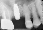 Site development remained in place to allow a longer fixture at the time of implant placement.