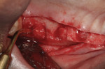 Piezosurgery used in conjunction with trephine cores to facilitate core detachment and apical repositioning.
