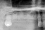 Radiograph following multiple site elevations for an uneven sinus floor using the trephine core in conjunction with the piezosurgery.