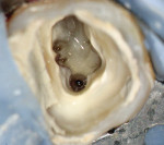 Figure 6  An upper first molar showing conservativeshaping in the MB2 and MB3 canals.