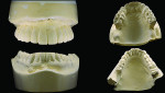 Fig 4 through Fig 8. Casts of the implant abutments, bridge in place, implant-level verified cast, and opposing cast.