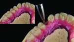 Fig 13 and Fig 14. A bilaterally screw-retained try-in with teeth in wax is performed at the second patient appointment, completely avoiding centric and vertical recording.