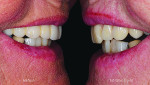 Fig 15 and Fig 16. A natural smile is restored, and natural-looking surface texture returns to the patient's smile.