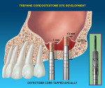 The core is gently tapped to elevate the Schneiderian membrane. The largest osteotome that fits within the trephine is used.