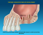 Particulate bone is used to aid in imploding the core apically and elevating the sinus floor.