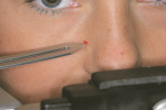 Figure 8  After placing the mark with the referencelocator, the adjustable reference pointer canbe consistently aligned. This is very helpful whentaking multiple facebows on a patient over time.