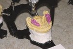 Figure 10  Once both casts have been mounted,all that needs to be programmed is thecondylar inclination. The simple protrusive biterecord will be used for this task.