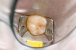 Figure 1  Preoperative view of tooth No. 30isolated by rubber dam.