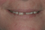 Fig 2. Tooth No. 8 had shifted labially, and the incisal edge was outside of the wet and dry lip border.