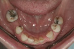Fig 9. Distal shift of the premolars as a consequence of missing molars.