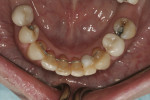 Fig 16. Final lower arch showing interdental spaces closed, implant-retained porcelain-fused-to-metal crown in the space of No. 29, and bonded composite pontic in the place of No. 23.