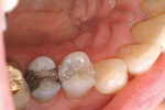 Figure 11  Composite build-up in place; toothready to be prepared for crown.