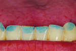Fi 6. Mandibular incisal wear pattern on the incisors and cuspids.